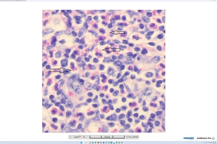 Ever Seen Eosinophils Under a Bright-Field Microscope? Take a Look at This