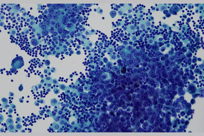 Lung cancer is one of the leading causes of cancer-related death worldwide.